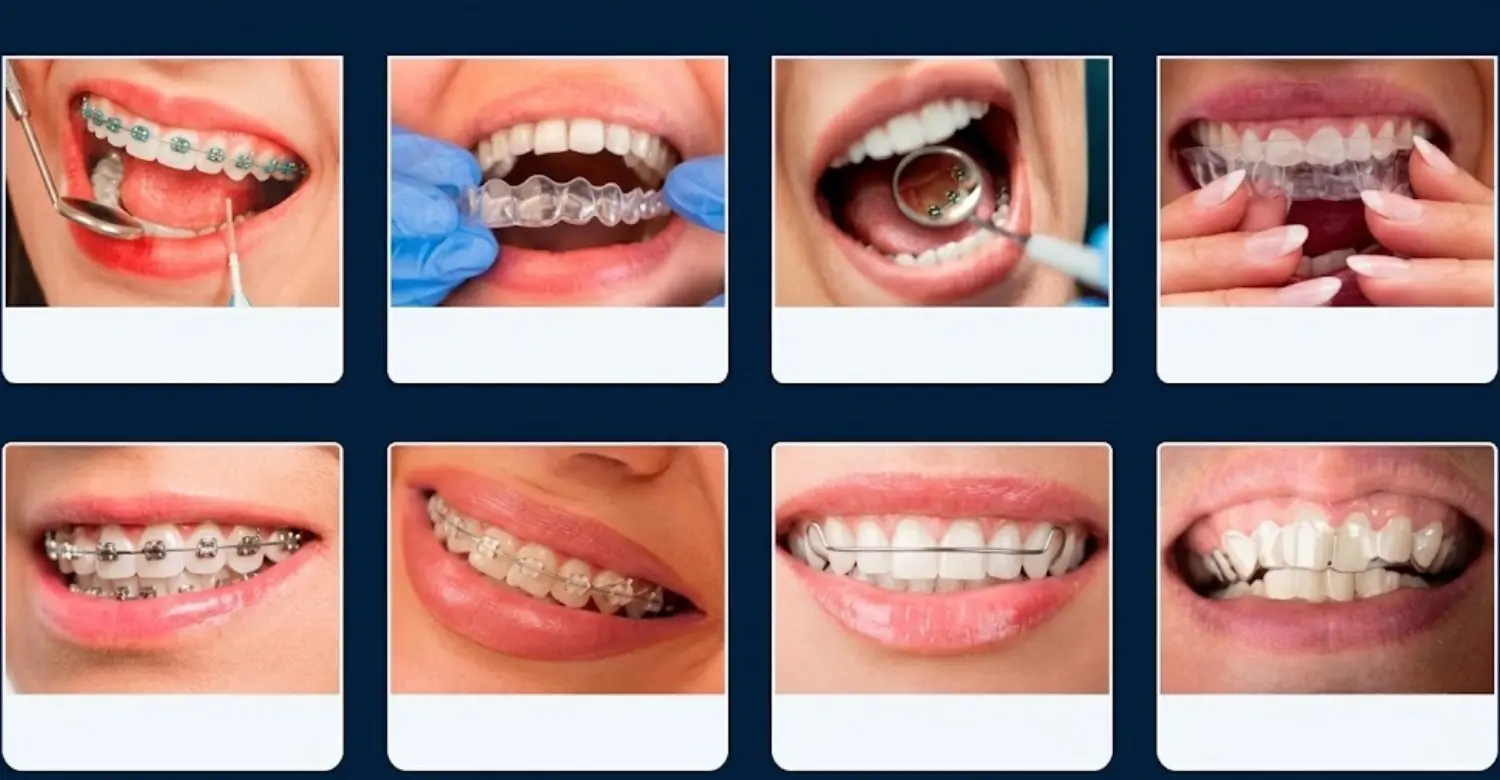 Invisalign alternatives 2